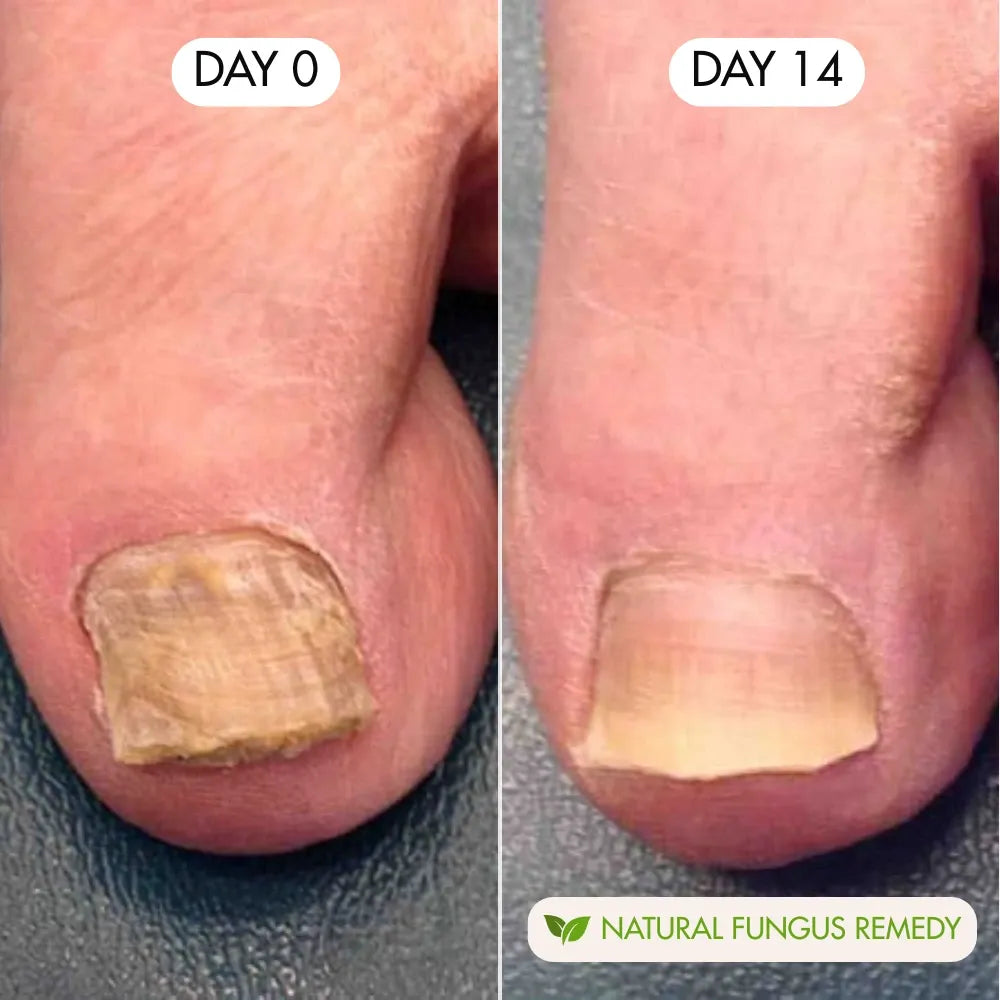 Nail Treatement - Natural antifungal care