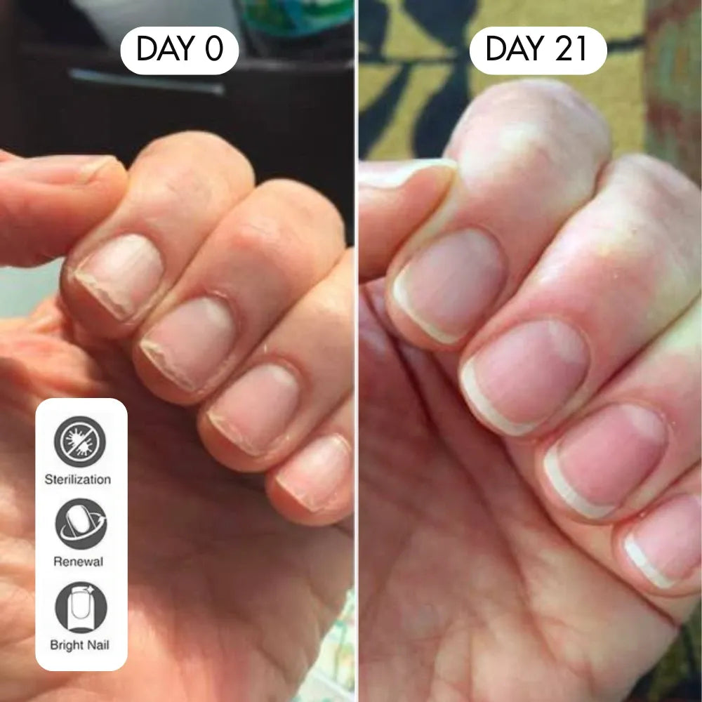 Nail Treatement - Natural antifungal care