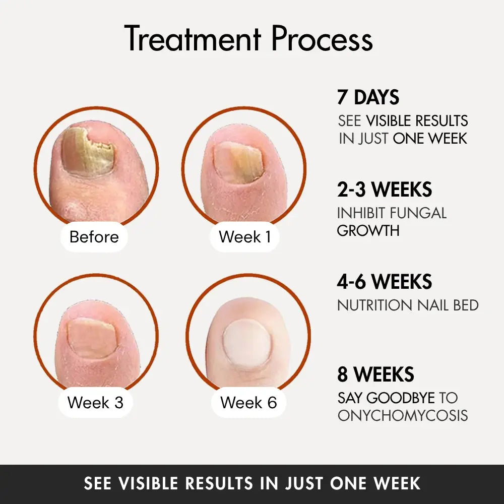 Nail Treatement - Natural antifungal care