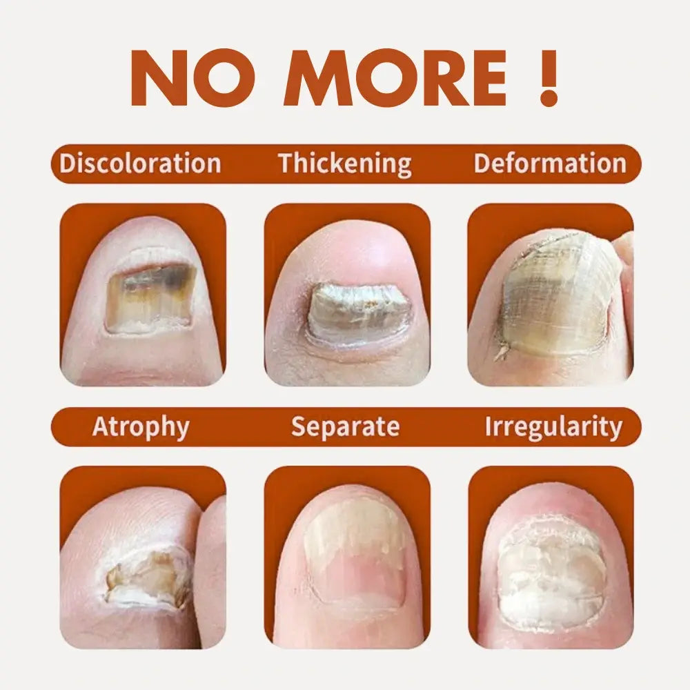 Nail Treatement - Natural antifungal care