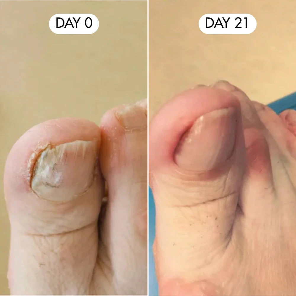 Nail Treatement - Natural antifungal care